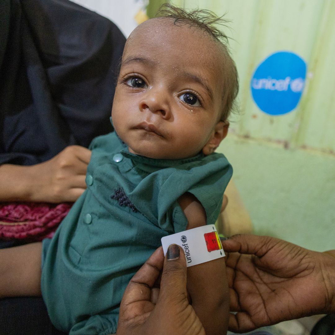 Hassan receiving treatment for malnutrition